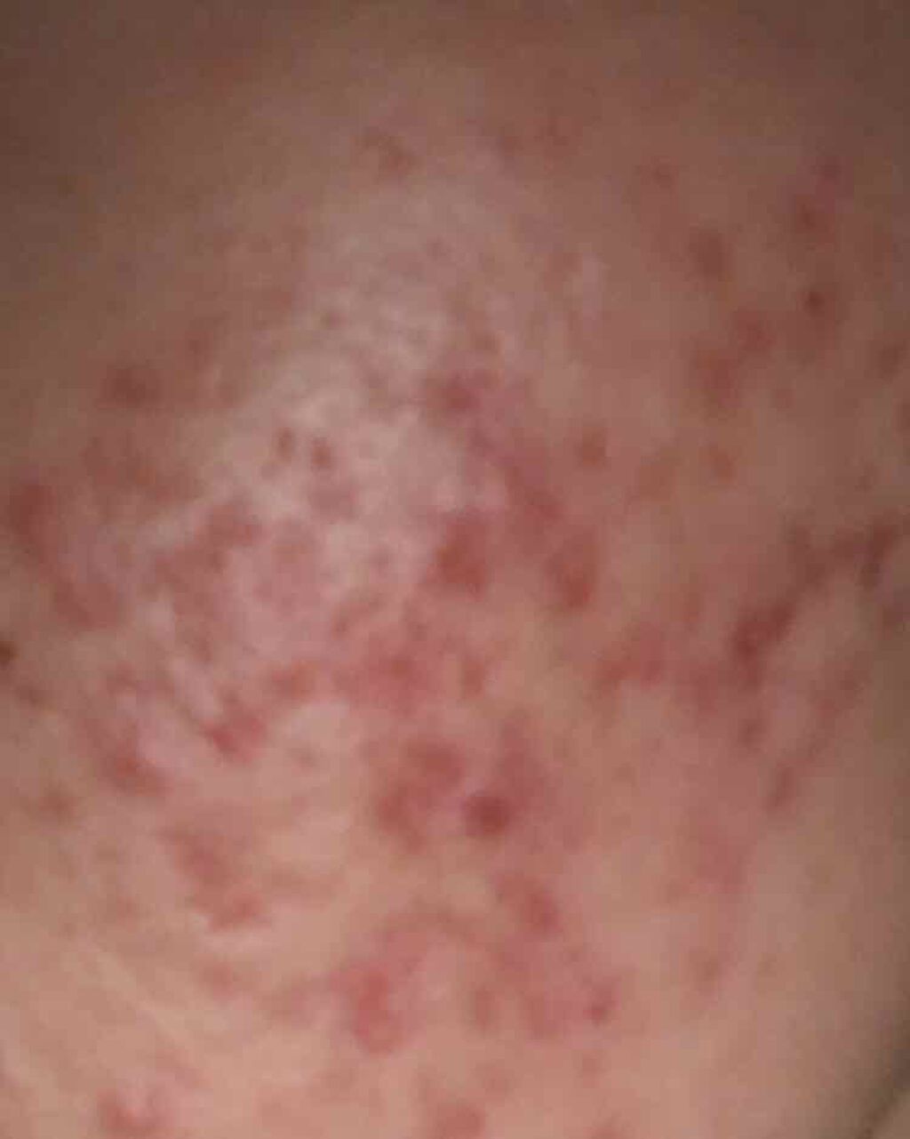 まいまい on LIPS 「初めての投稿です。私はいまひどいニキビで悩んでいます。ココ最近..」(3枚目)