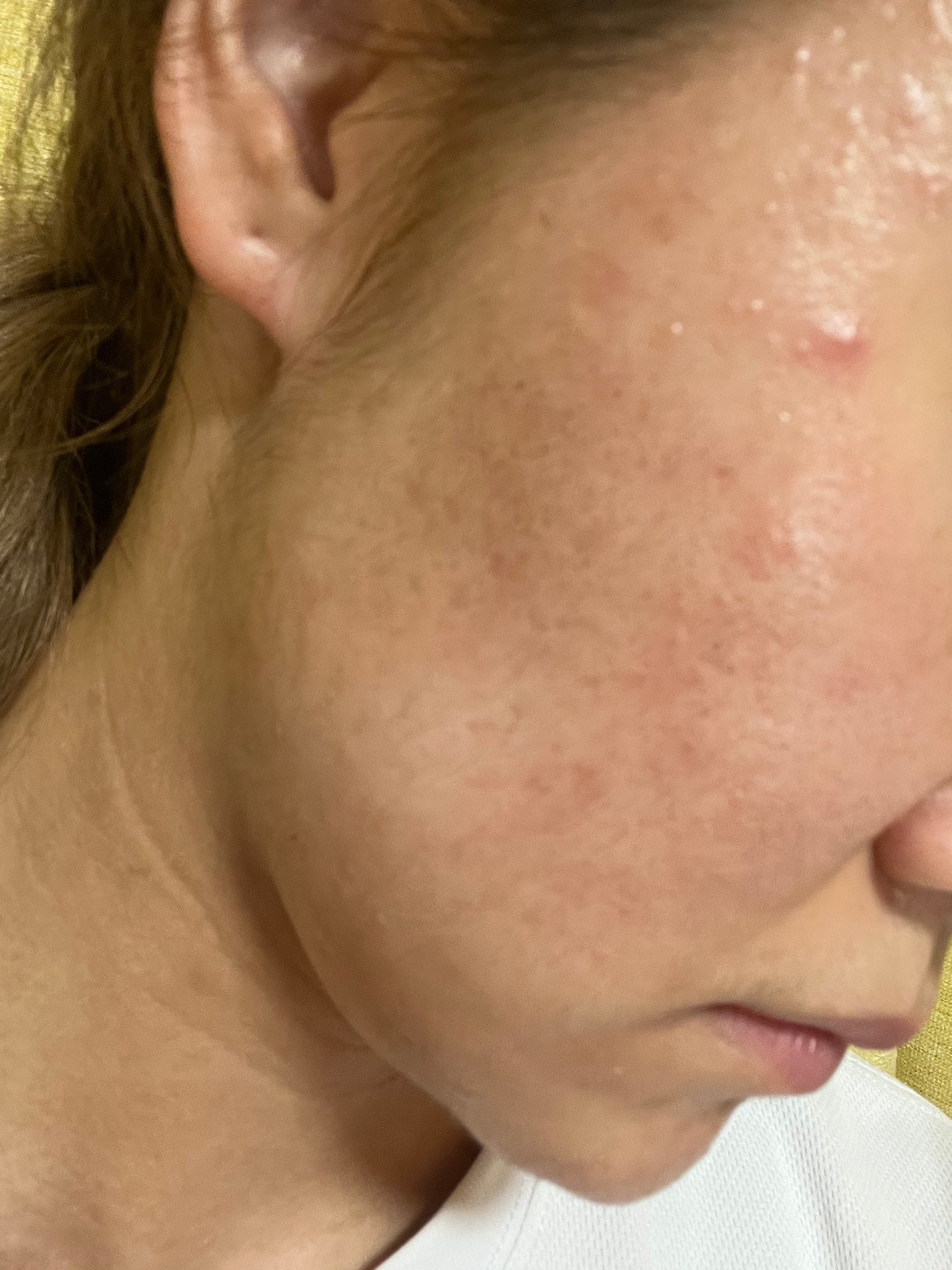 あーちゃん on LIPS 「皮膚科で処方されたアダパレンを塗り始めて1週間☝🏻んーん、..」(2枚目)