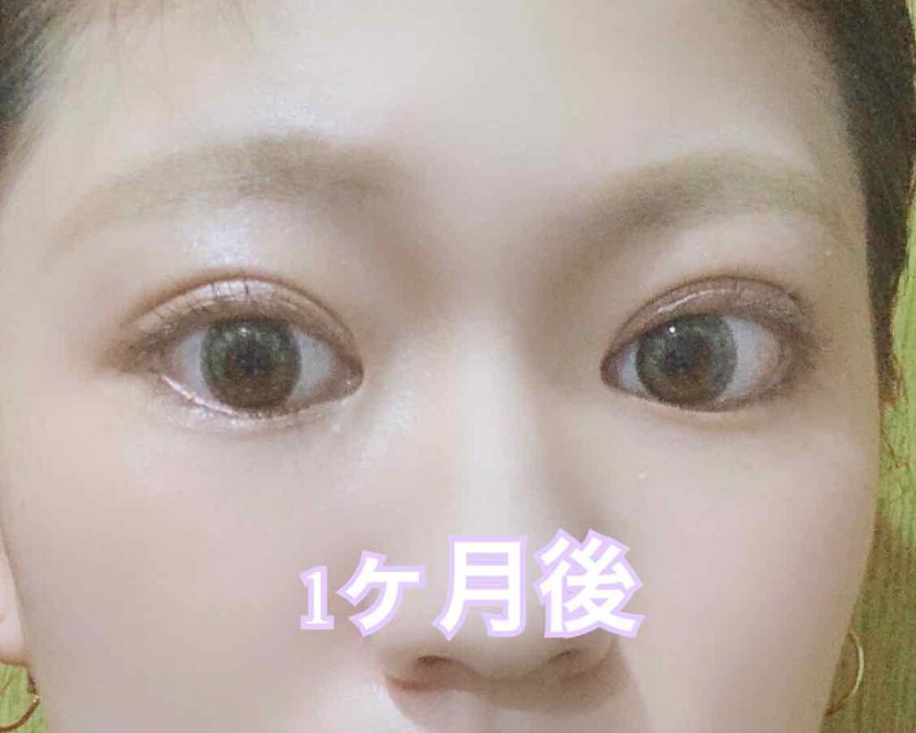 ITSUKI on LIPS 「私がやったクイックコスメティークダブルの二重施術は切らないタイ..」(3枚目)