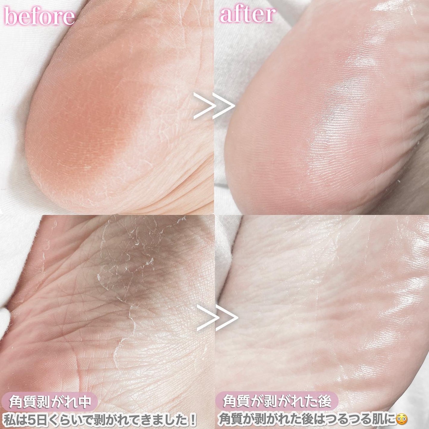 あしやすめ 足裏角質ケアパック/鎌倉ライフ/レッグ・フットケアを使ったクチコミ(6枚目)
