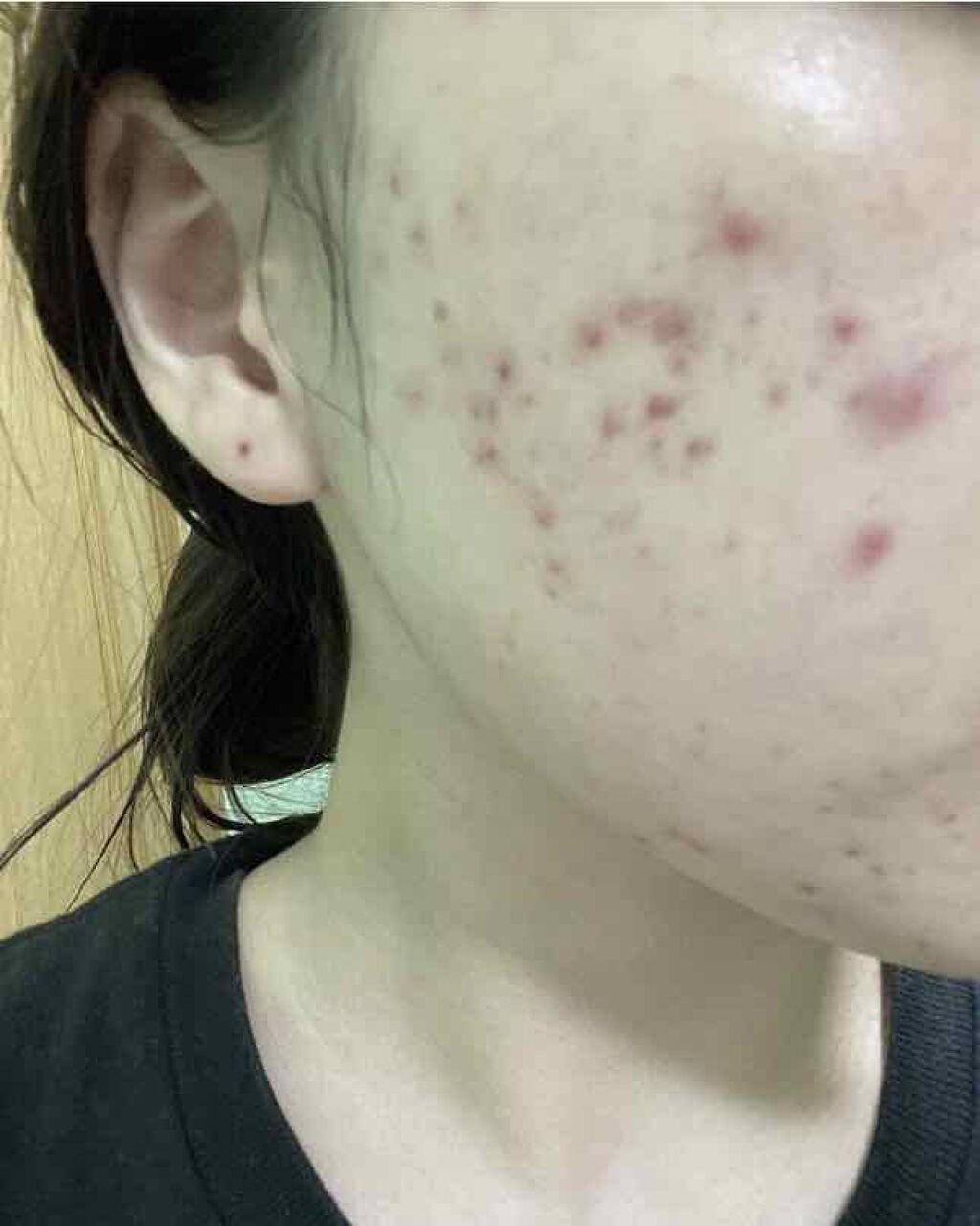 Glycolic Acid 7% Toning  Solution/The Ordinary/ブースター・導入液を使ったクチコミ（1枚目）