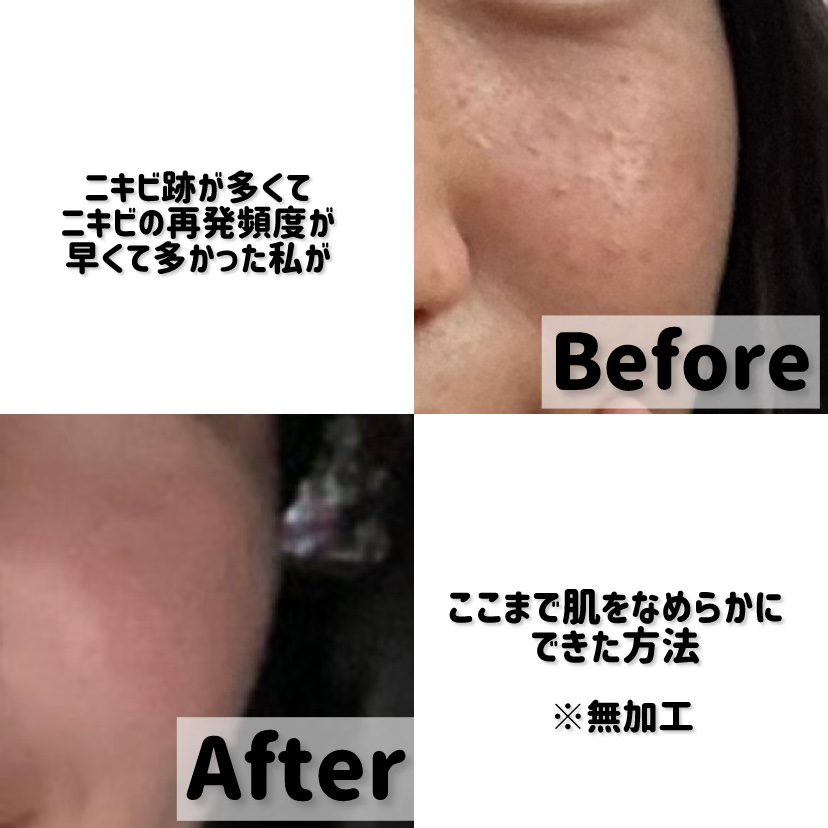 ダーマレーザー ウルセラC/クオリティファースト/美容液を使ったクチコミ（1枚目）