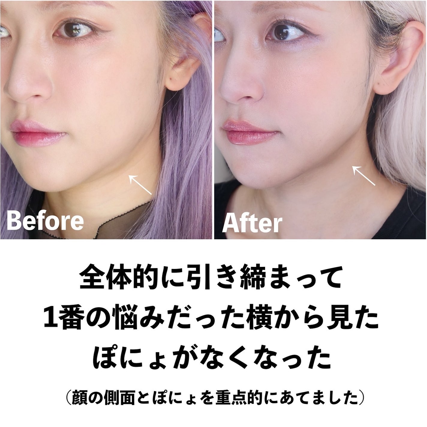 とみりー on LIPS 「ハイフ本音レポ!過去にも美容医療レポを何回もしていて、その時..」(3枚目)