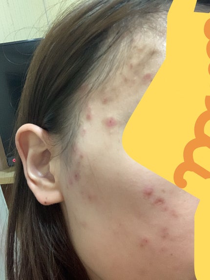 薬用ニキビケア スポッツクリーム/アクネスラボ/フェイスクリームを使ったクチコミ(4枚目)