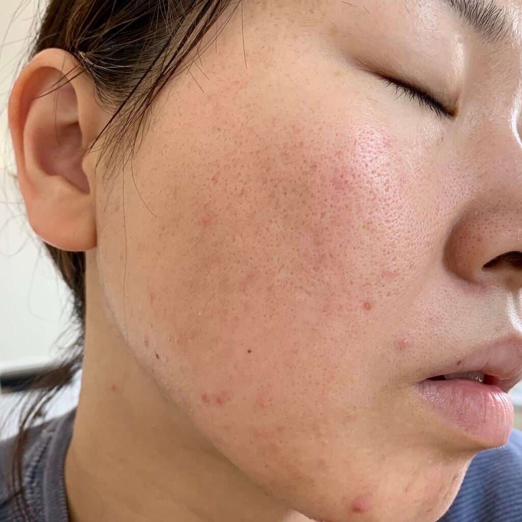 ティーツリーカーミングエッセンスパッド/MEDIHEAL/トナーパッドを使ったクチコミ(6枚目)