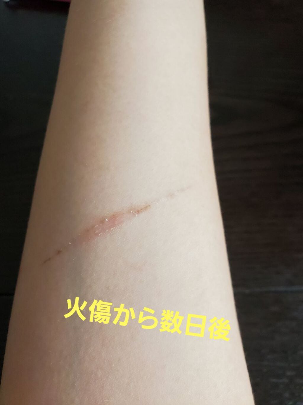 アットノンEX クリーム(医薬品)/アットノン/その他を使ったクチコミ(3枚目)