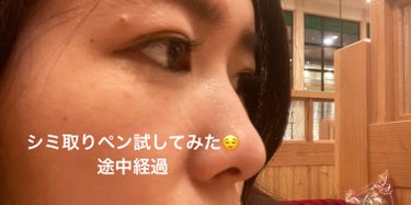 ふぁるるん on LIPS 「sheinで買ったシミ取りペン使ってみました✨麻酔なしですごく..」（1枚目）