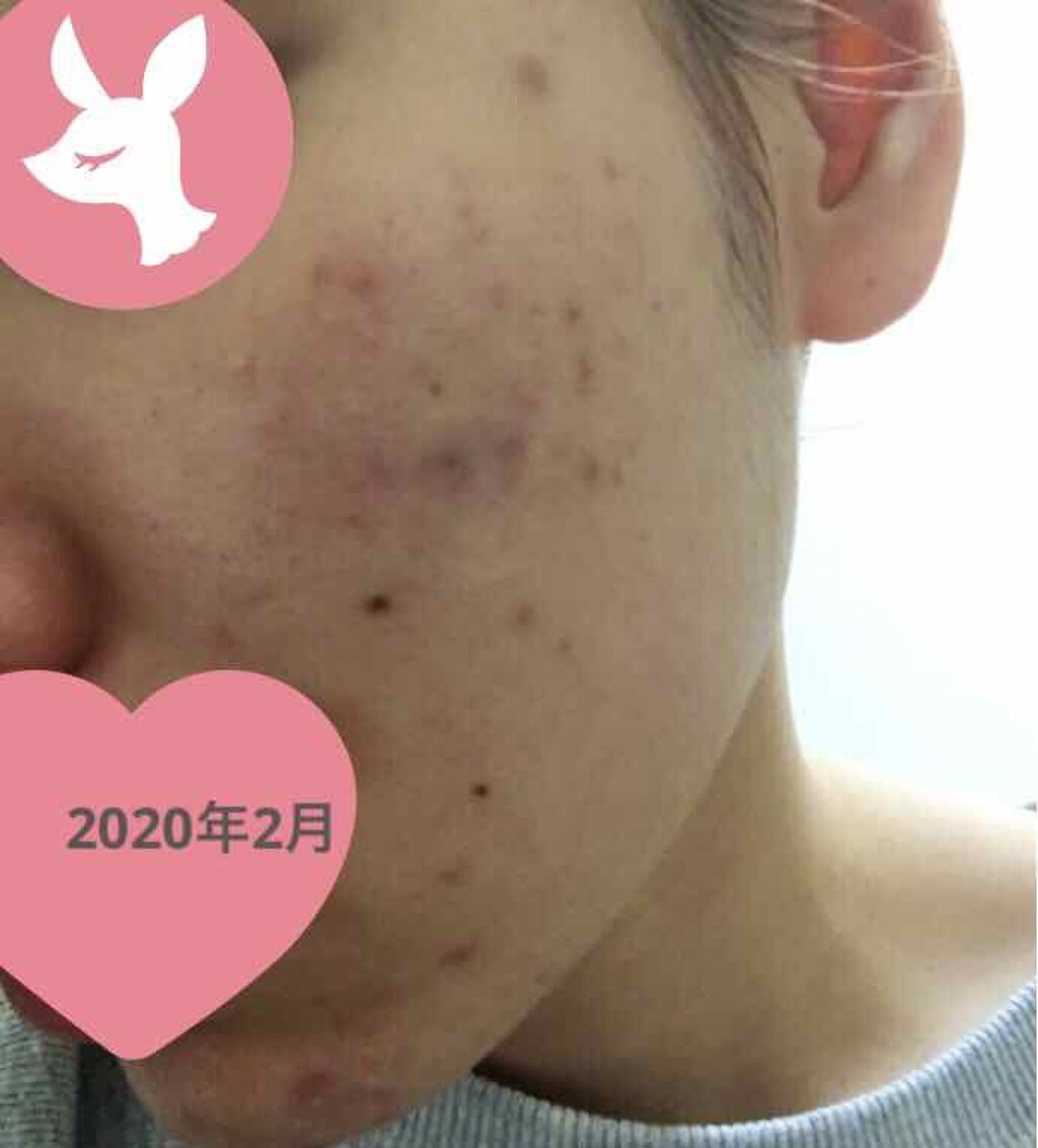 ベピオゲル/マルホ株式会社/その他を使ったクチコミ（1枚目）