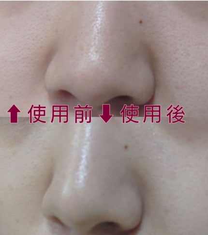 アンチポアブラックヘッドパーフェクトクリアキット/CNP Laboratory/シートマスク・パックを使ったクチコミ(3枚目)