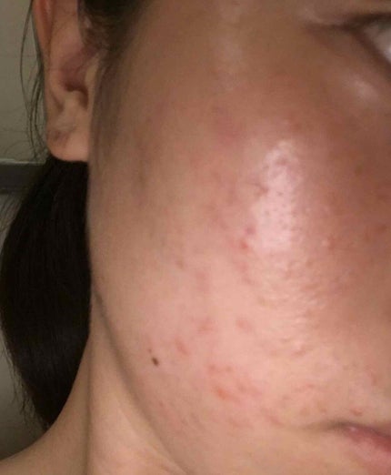 ベピオゲル/マルホ株式会社/その他を使ったクチコミ(1枚目)