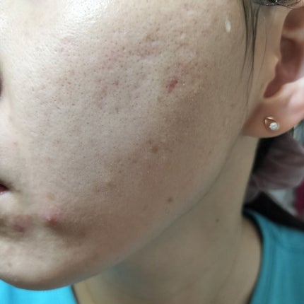 vitamin c suspension 30% in silicone/The Ordinary/美容液を使ったクチコミ(2枚目)