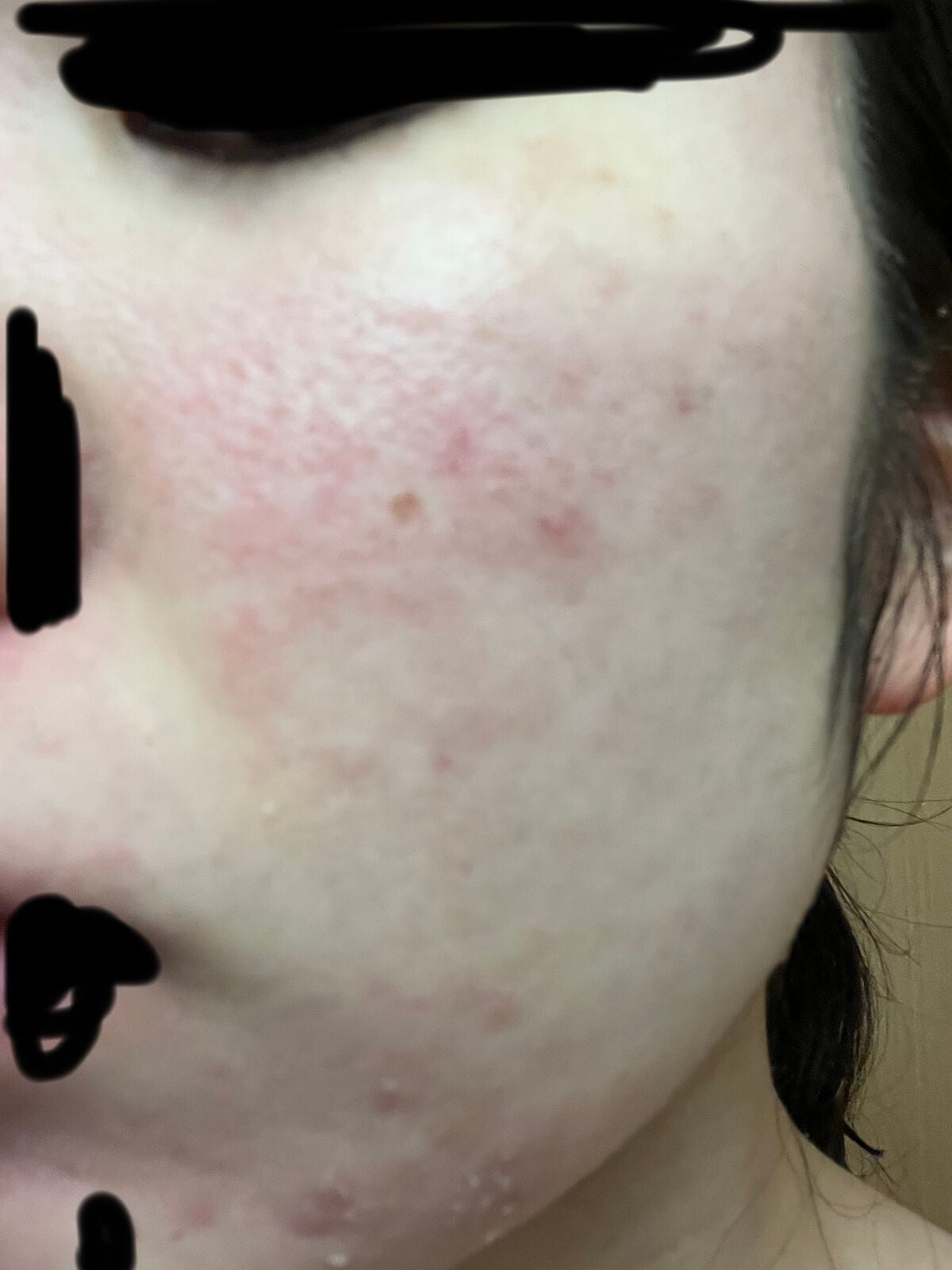 エピえぴ。 on LIPS 「2022.6/7〜皮膚科へ。エピデュオゲル処方記録開始皮剥けあ..」(1枚目)