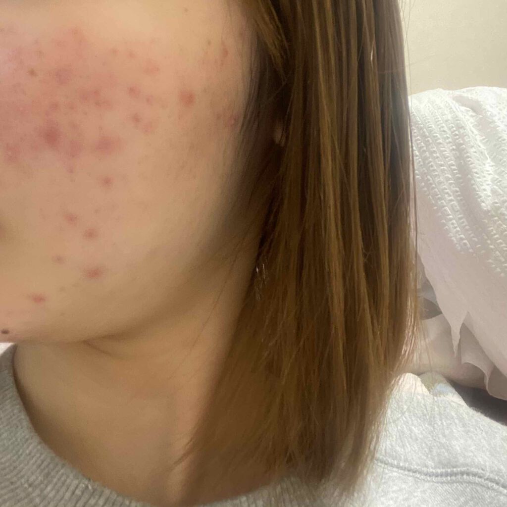 クリンダマイシンゲル(医薬品)/クラシエ薬品/その他を使ったクチコミ（2枚目）