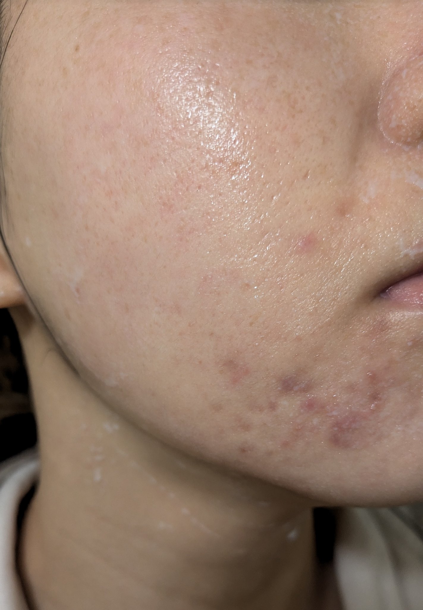 11/17の#汚肌工事録

ダメージすごい！
この頃写真見たくなくて見れてなかったけど、
ちゃんと見るとダメージがまず良くないってわかる…😂