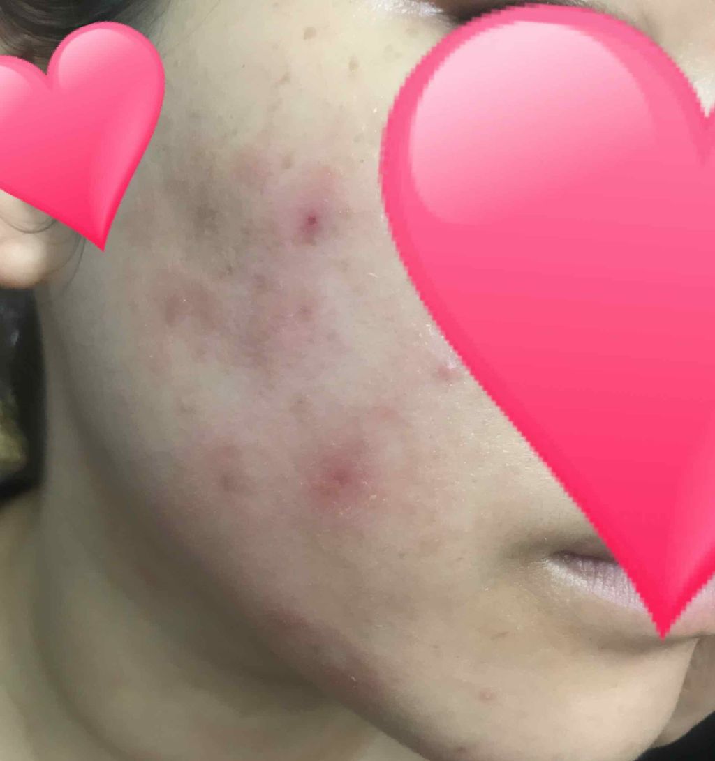 ハンガー on LIPS 「私はデュアック配合ゲルの副作用が酷かったのでデュアックより1段..」(2枚目)