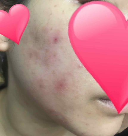 ディフェリンゲル0.1% /マルホ株式会社/その他を使ったクチコミ(2枚目)