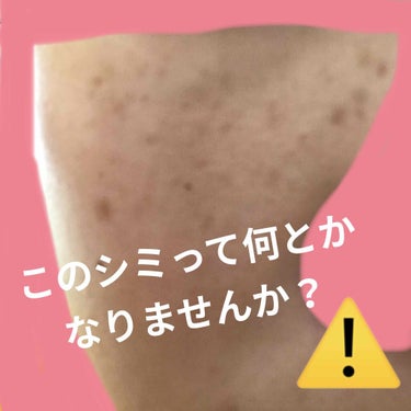 誰か助けて欲しいです😭😭
3つあります！


⒈シミって化粧で隠すことは出来ますが
完全に消すってことは無理なのでしょうか？

なにかいい方法がある人教えてください


⒉鼻の黒ずみって取れる方法ありま