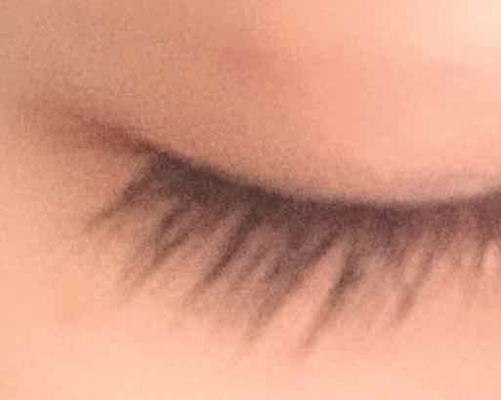 ゆーりかの葉っぱ on LIPS 「埋没7日目です☆*°左眼はもうほとんど赤みが消えました!でも、..」(3枚目)