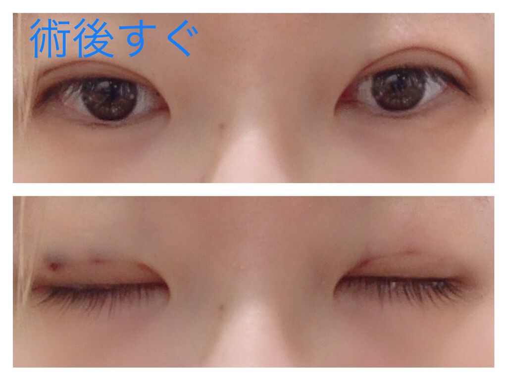 二重整形/その他を使ったクチコミ（3枚目）