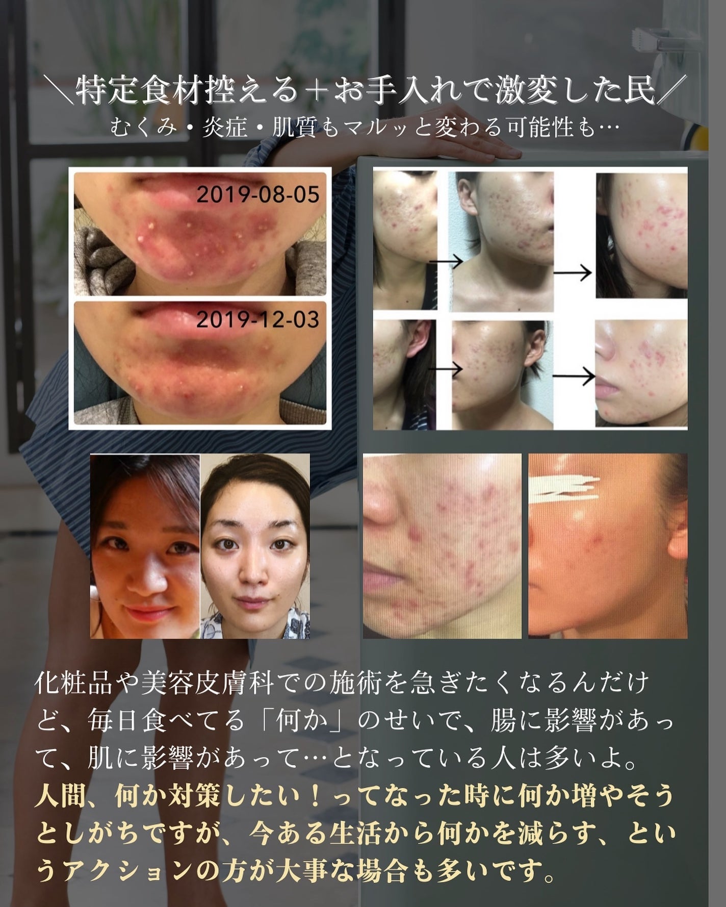 おゆみ|ニキビ・ニキビ跡ケア on LIPS 「【病院行くほどじゃないけど…っていう不調×ニキビ肌は要チェック..」(7枚目)