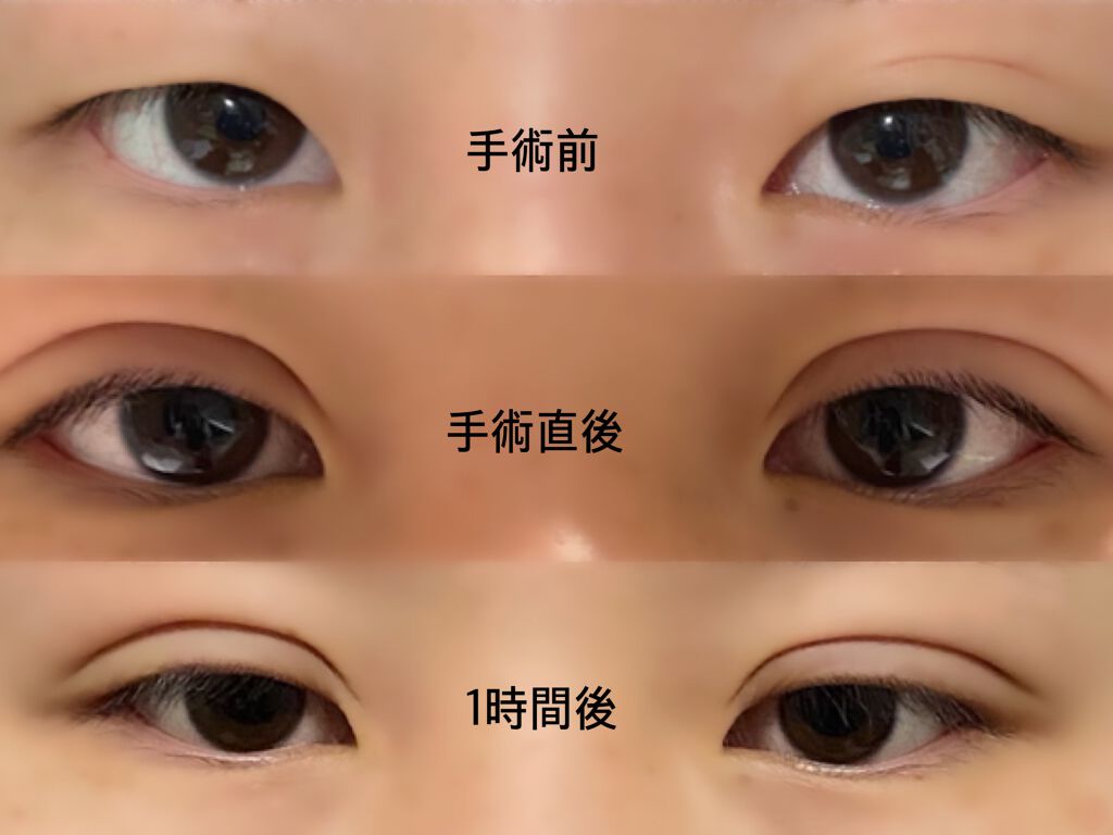 Mol on LIPS 「【念願の二重に】 ずっと悩んでいた埋没手術を受けて来ました。プ..」(2枚目)