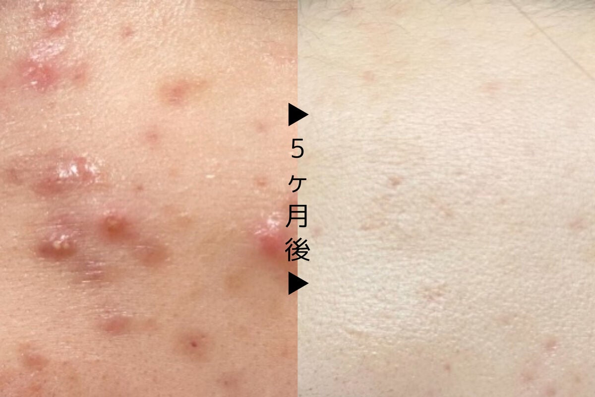 A アクネフォーム/NOV/洗顔フォームを使ったクチコミ(1枚目)