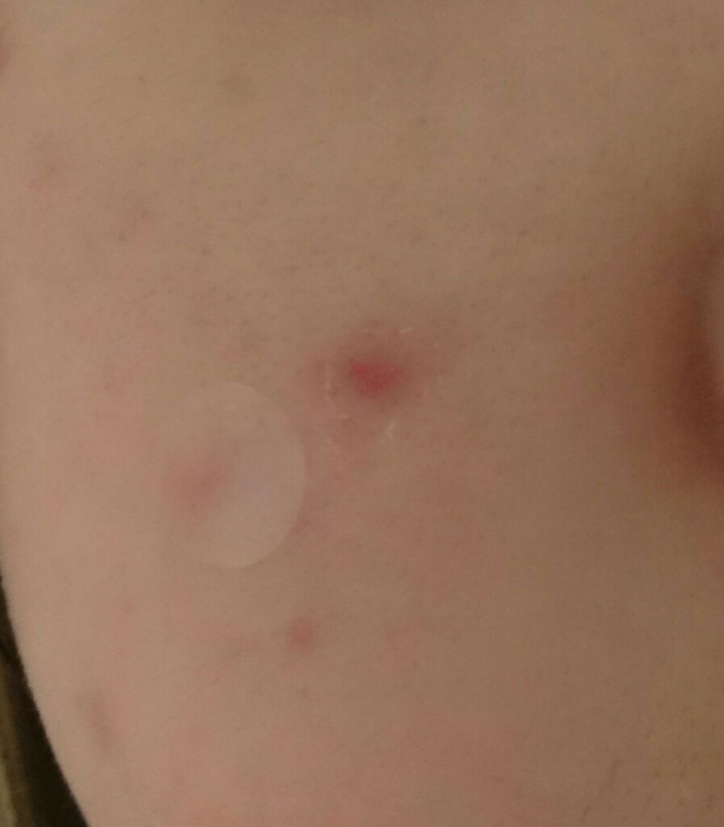 Secret solution Clear Patch/It's skin/シートマスク・パックを使ったクチコミ（2枚目）