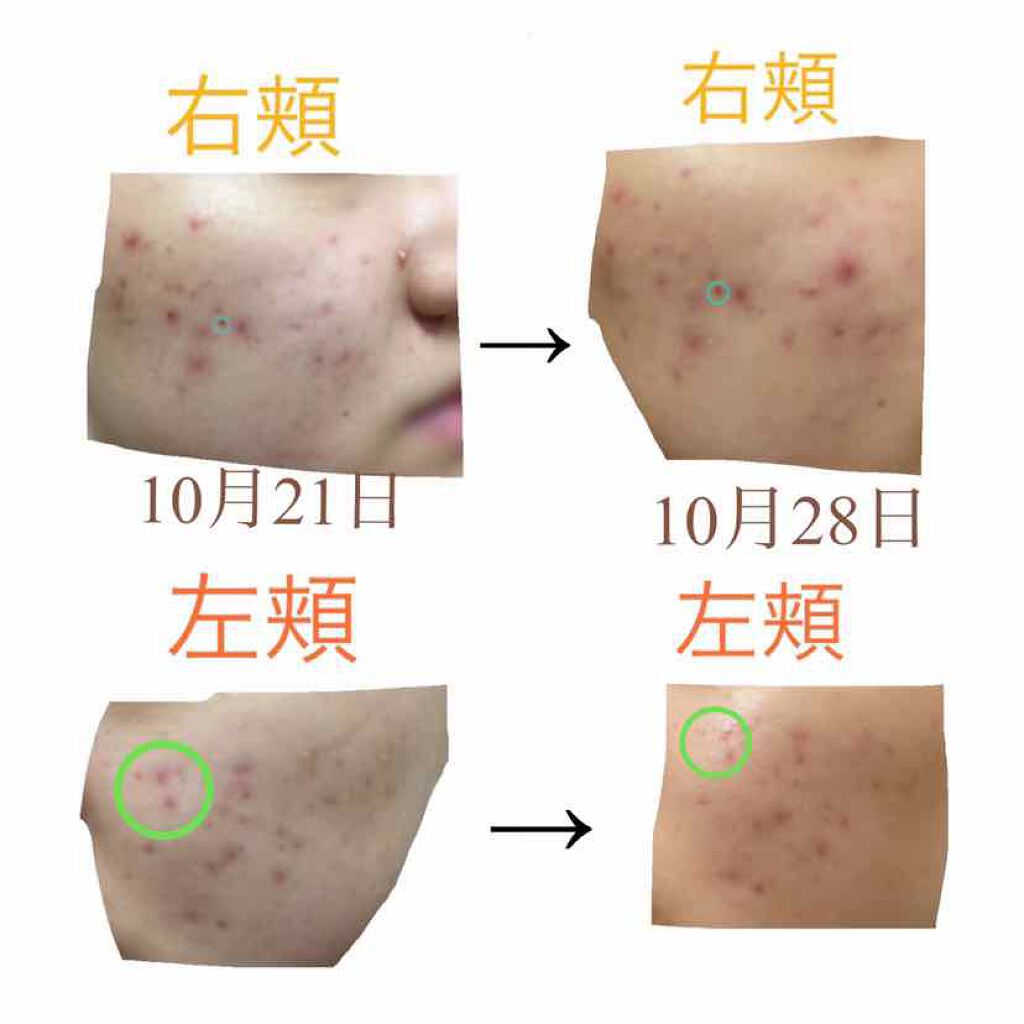 薬用 しみ 集中対策 美容液/メラノCC/美容液を使ったクチコミ(2枚目)