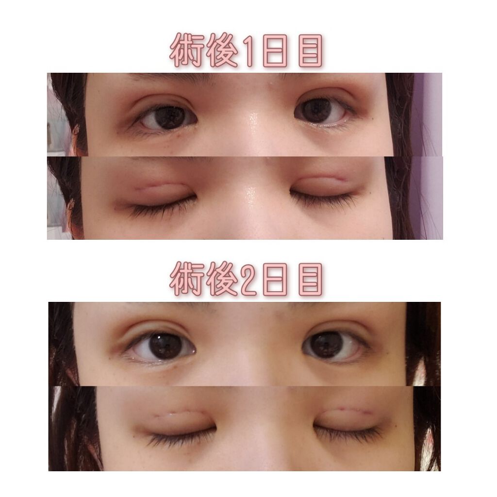 二重整形/その他を使ったクチコミ（2枚目）