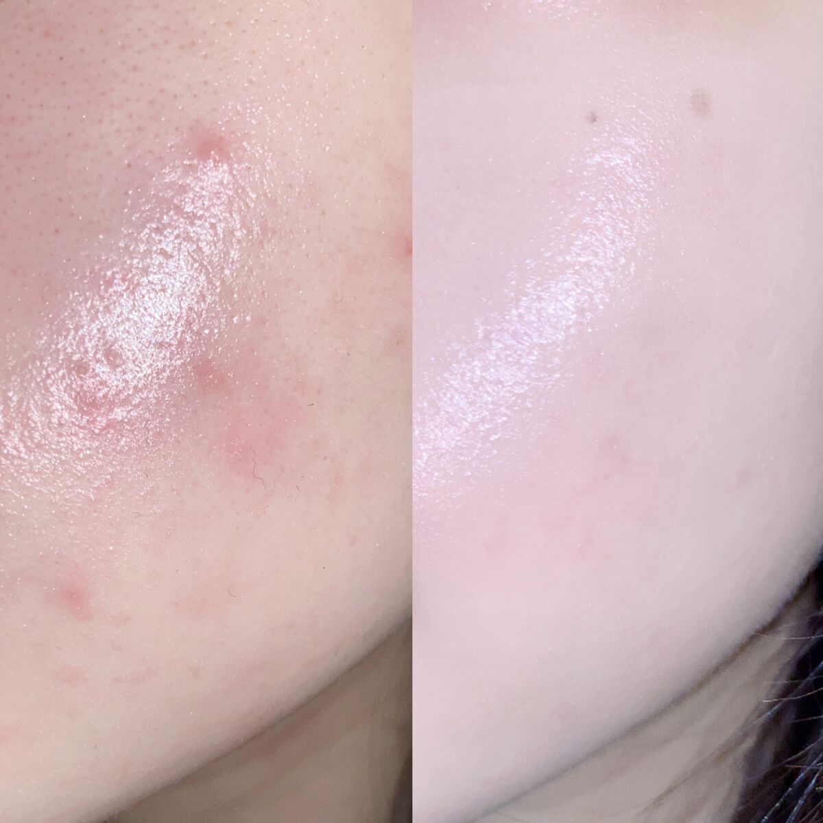 はるかの美容垢🐰 on LIPS 「肌荒れを改善したい全ての方へ✨1ヶ月でここまで治りました!!!..」(3枚目)