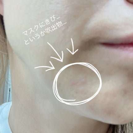 薬用ニキビケア スポッツクリーム/アクネスラボ/フェイスクリームを使ったクチコミ(6枚目)