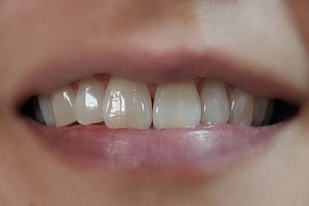 アパガードロイヤル/アパガード/歯磨き粉を使ったクチコミ(3枚目)