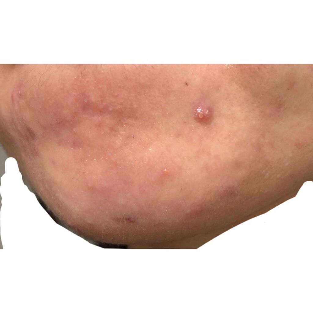 ベジータ on LIPS 「今週の肌 1.23ディフェリンゲル塗っても全然毛穴出てくれなく..」(2枚目)