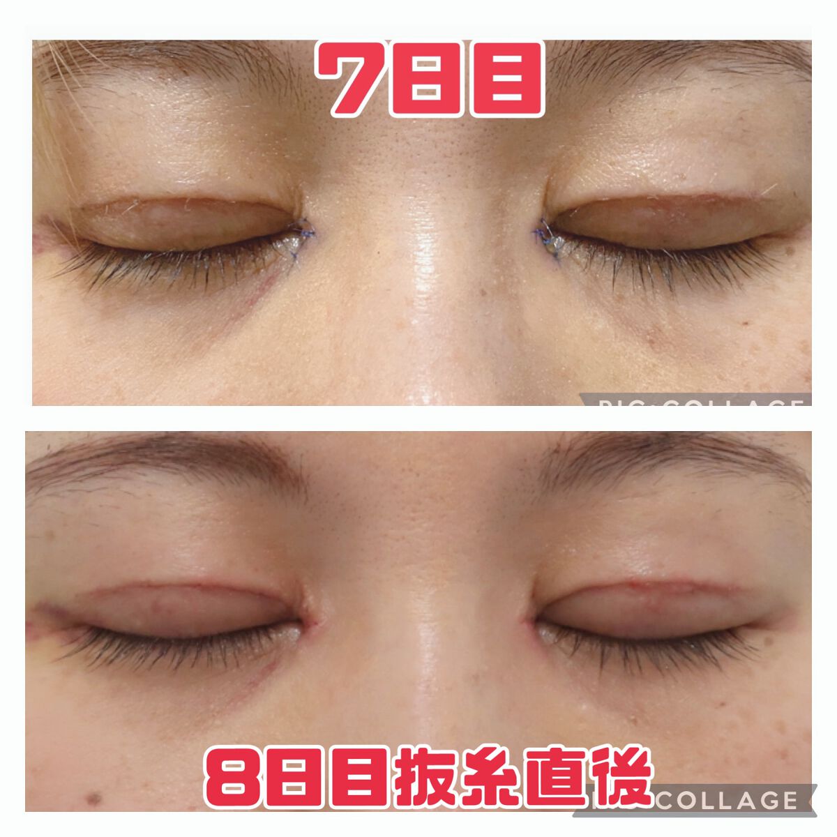 ふうせん @フォロバ100% on LIPS 「3月3日8日目抜糸の日抜糸直後なので少し赤みがあるかもしれない..」(2枚目)