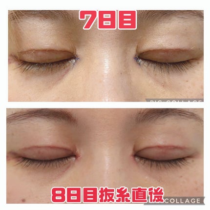 ふうせん @フォロバ100% on LIPS 「3月3日8日目抜糸の日抜糸直後なので少し赤みがあるかもしれない..」(2枚目)