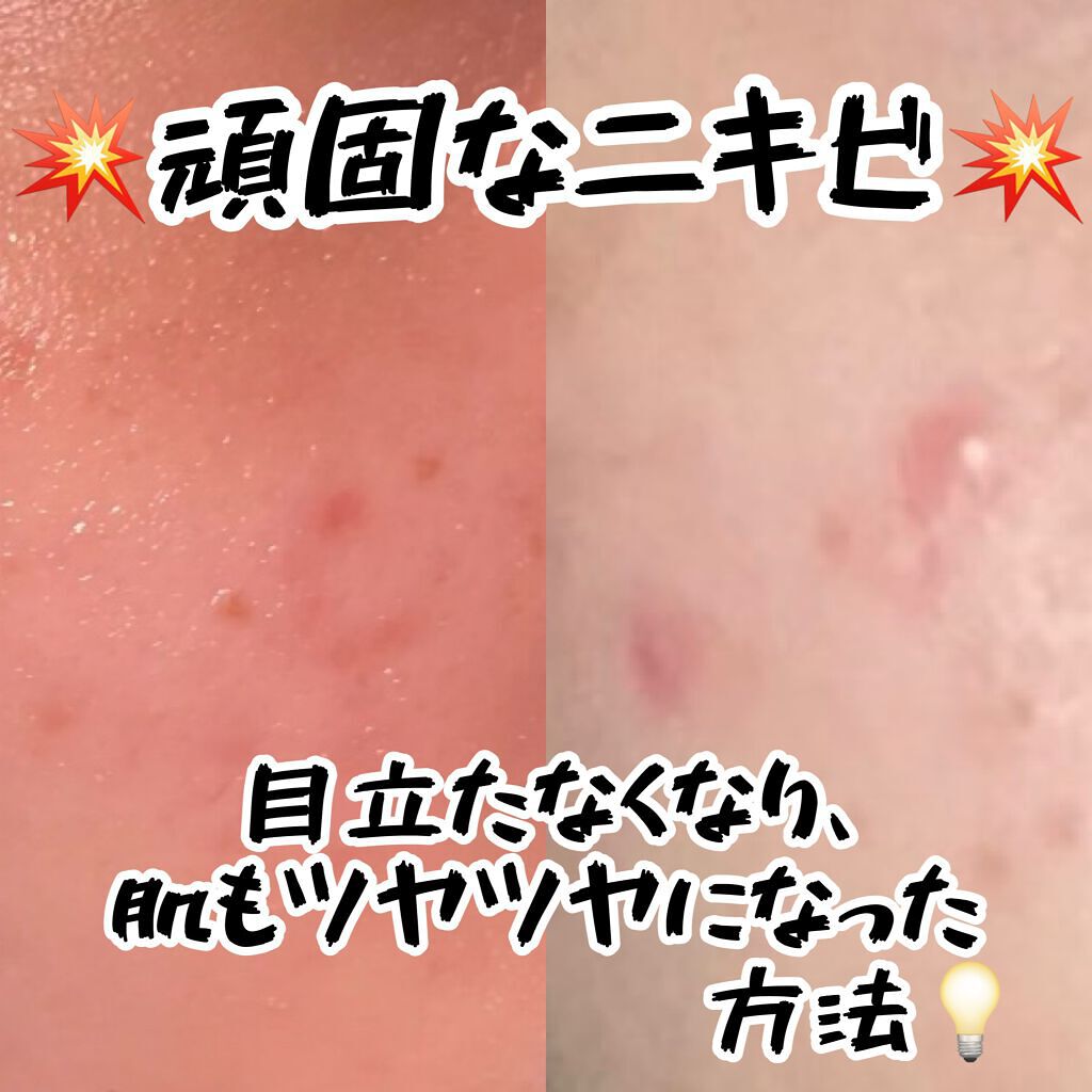 DHC ビタミンＣハードカプセル/DHC/美容サプリメントを使ったクチコミ（1枚目）