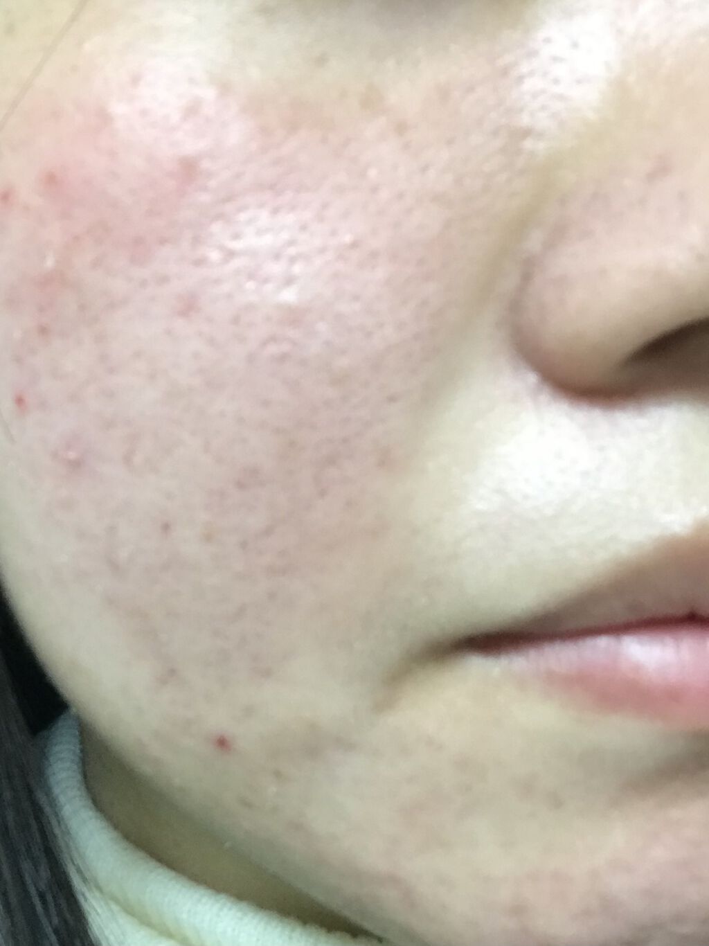 エピデュオゲル/マルホ株式会社/その他を使ったクチコミ（1枚目）