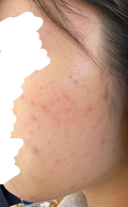 ディフェリンゲル0.1% /マルホ株式会社/その他を使ったクチコミ(2枚目)