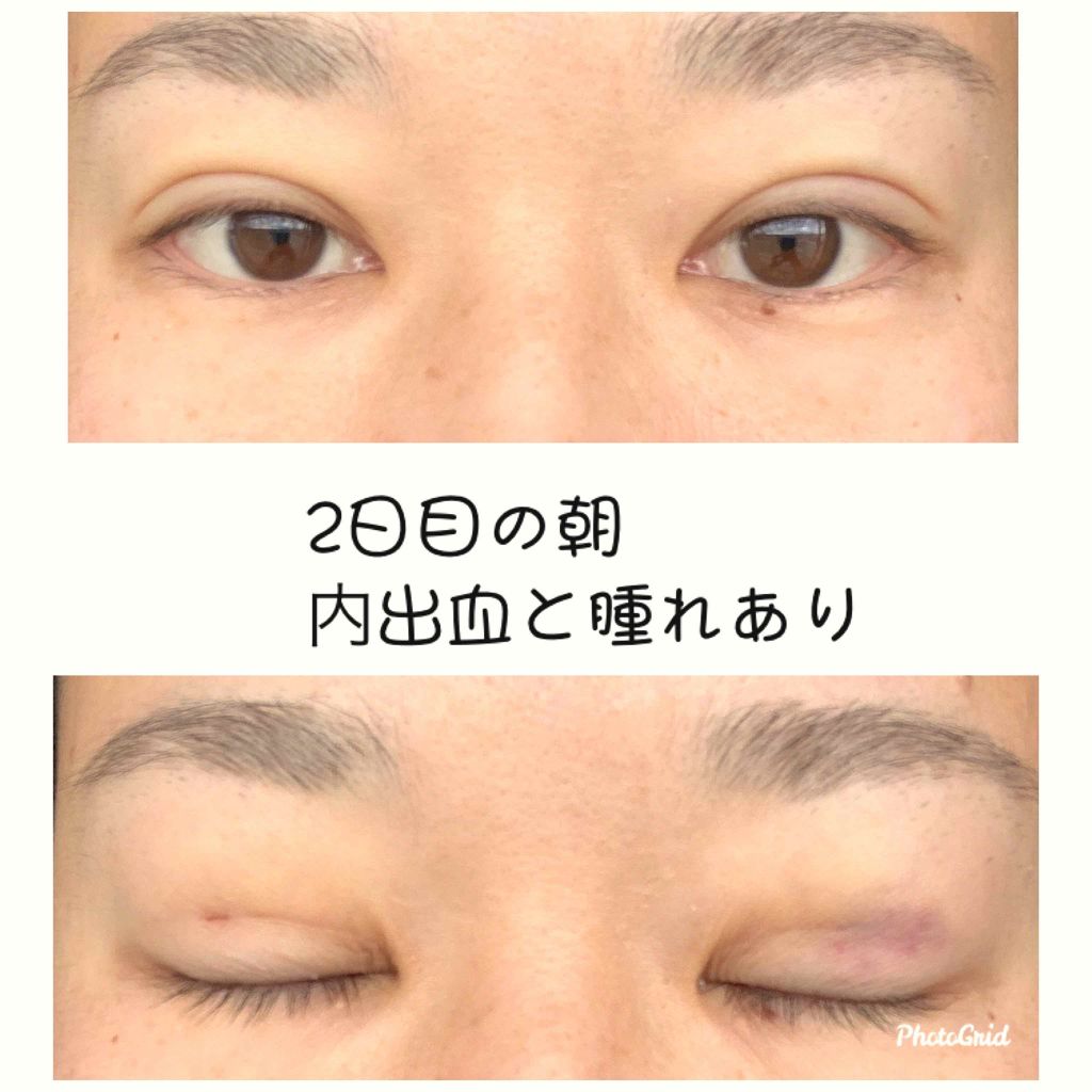 Meat on LIPS 「※気になる方は参考までに。。。二重整形しました。湘南美容外科で..」(4枚目)