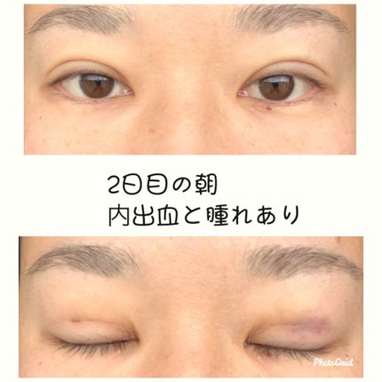 Meat on LIPS 「※気になる方は参考までに。。。二重整形しました。湘南美容外科で..」(4枚目)