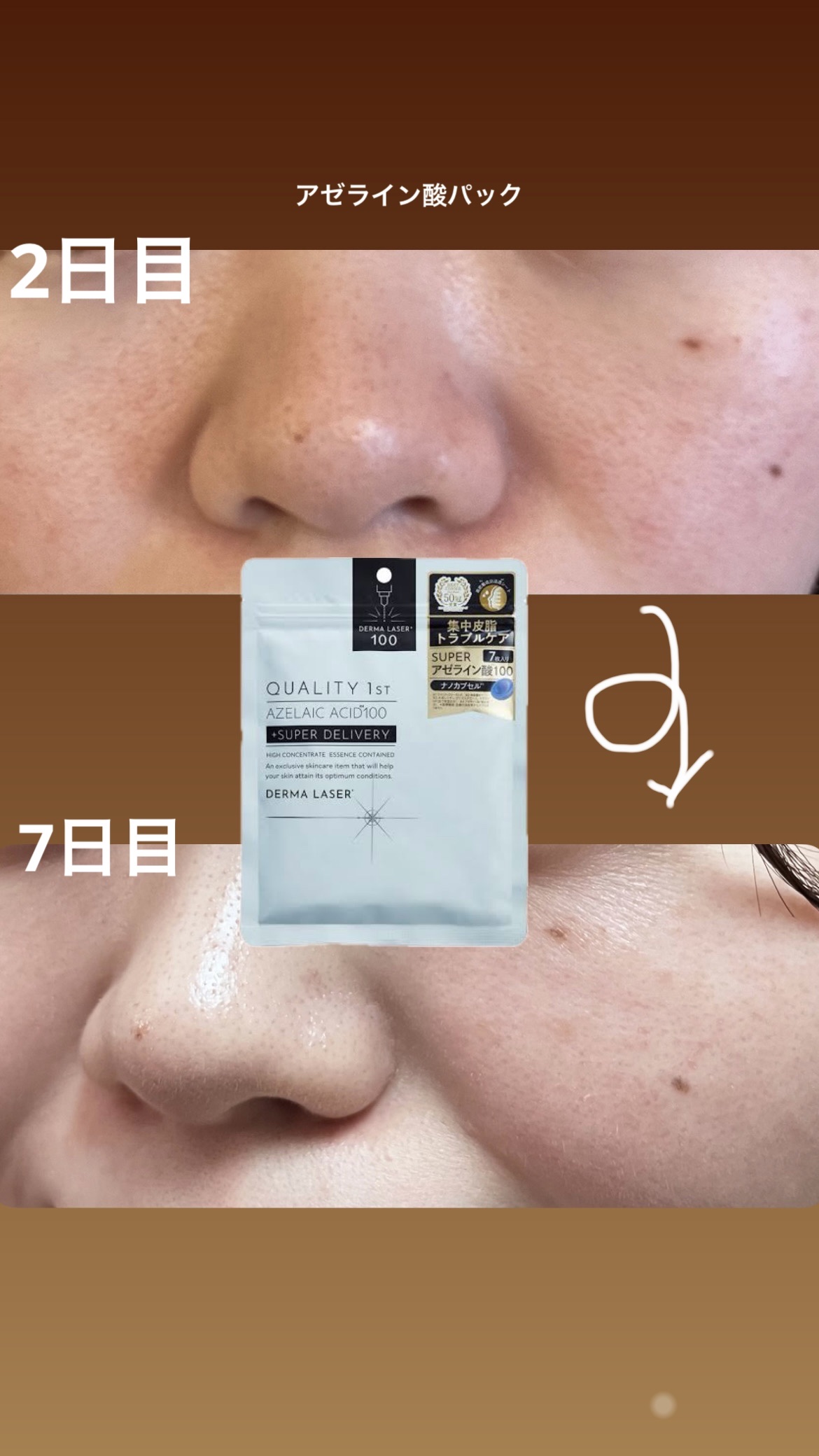 ダーマレーザー スーパーAZ100マスク/クオリティファースト/シートマスク・パックを使ったクチコミ（1枚目）