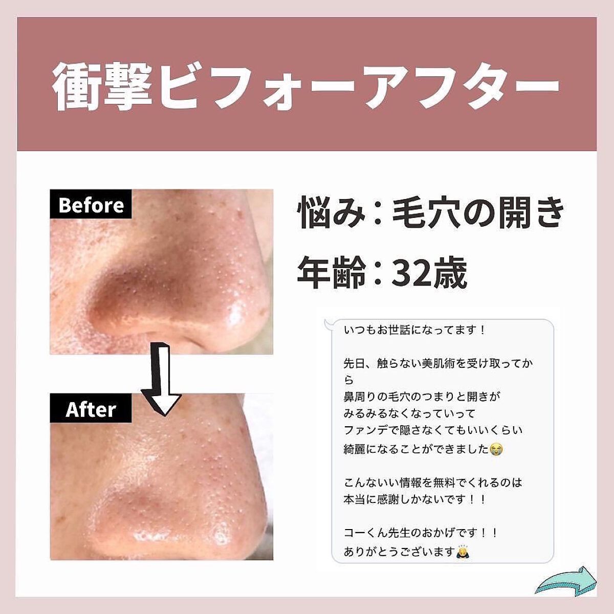 あなたの肌に合ったスキンケア💐コーくん先生 on LIPS 「【本当は教えたくない】毛穴の開き3日で消す方法.
.
あなたの..」(5枚目)