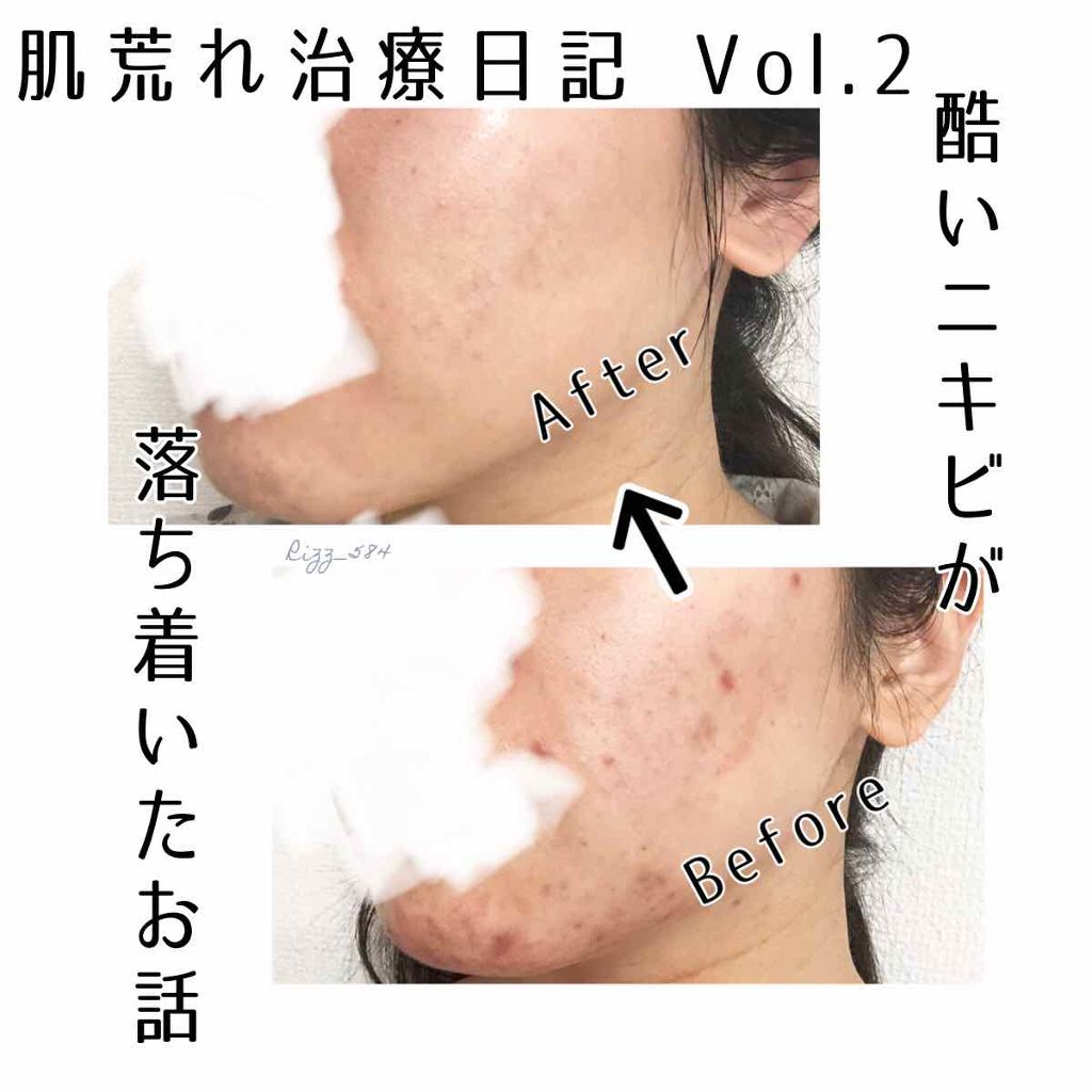 ａ アクネジェル Novを使った口コミ 肌荒れ治療日記vol 2 １枚目から汚い By Rizz 敏感肌 Lips