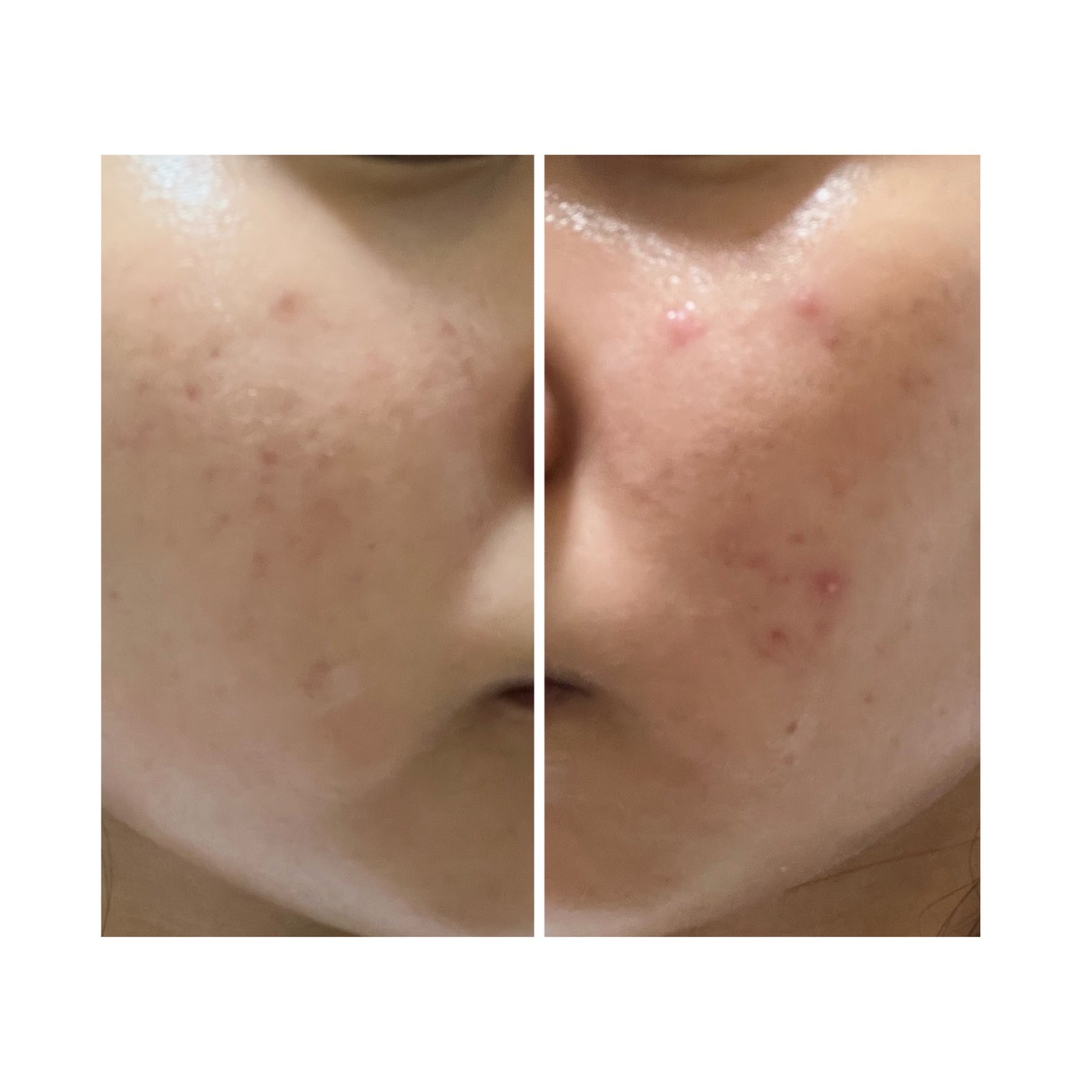 ぽむ on LIPS 「2023.9.13皮膚科に受診 エピデュオとヘパリン処方1枚目..」(2枚目)