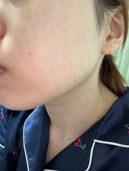 VC100エッセンスローション EX/ドクターシーラボⓇ/化粧水を使ったクチコミ(3枚目)