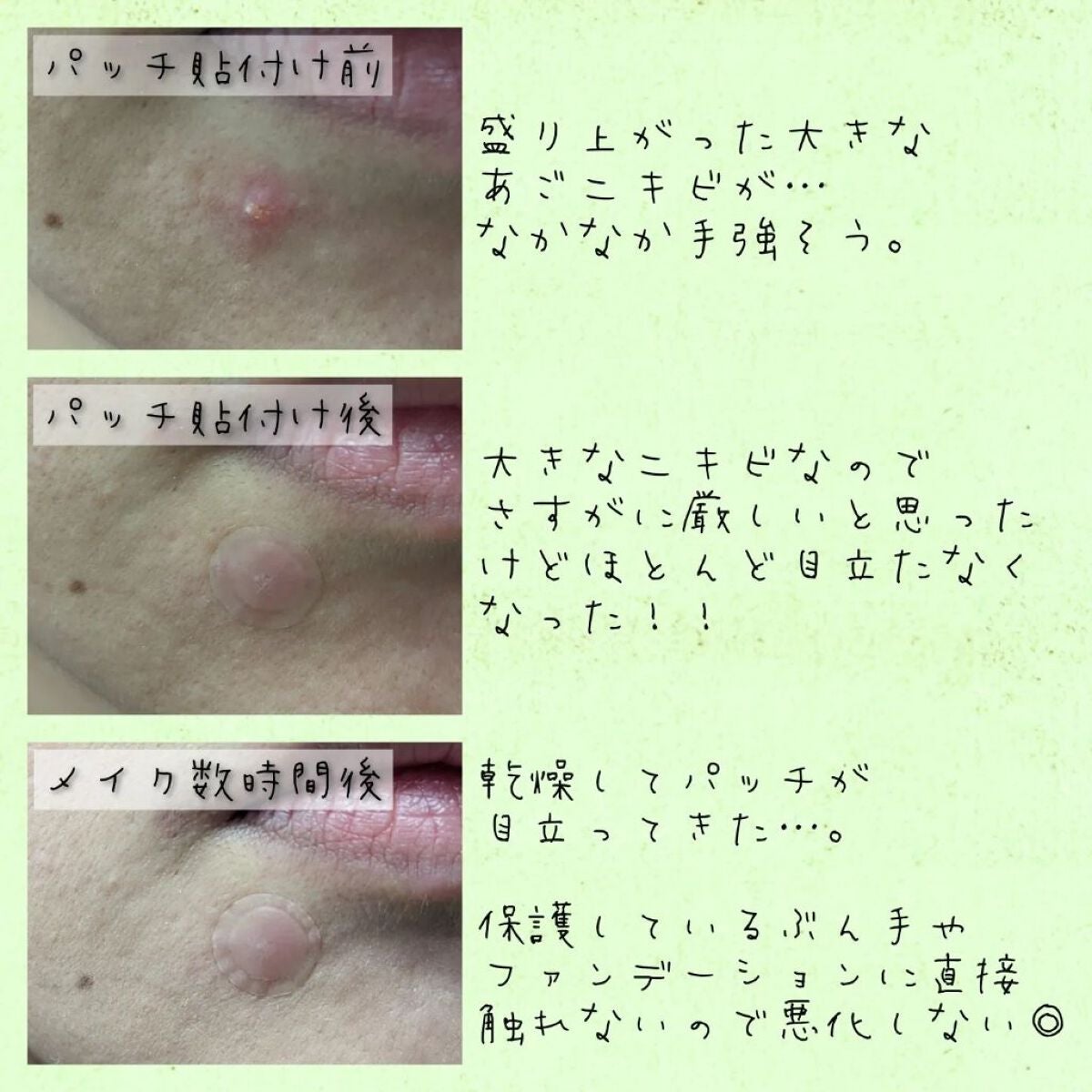 ゼロスポットパッチ/Today’s Cosme/にきびパッチを使ったクチコミ(3枚目)