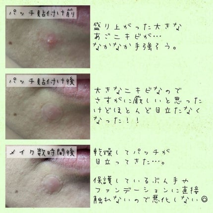 ゼロスポットパッチ/Today’s Cosme/にきびパッチを使ったクチコミ(3枚目)