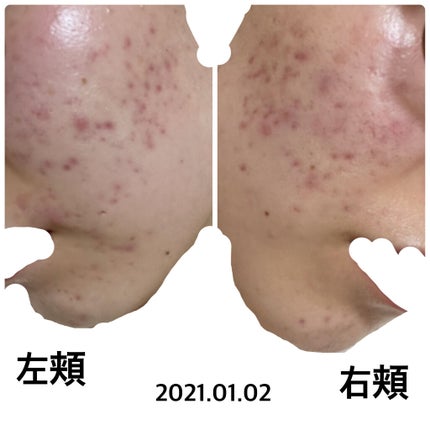 ミノン アミノモイスト 薬用アクネケア ローション/ミノン/化粧水を使ったクチコミ(1枚目)