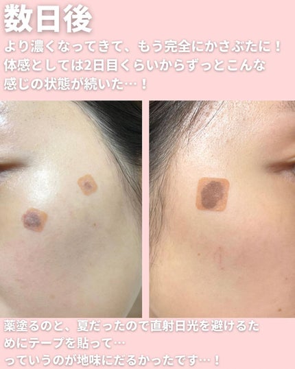 mii♡イエベ春🌸フェミニン on LIPS 「シミとりレーザー感想と経過をまとめました💁🏻♀️✨同じ悩みの..」(6枚目)