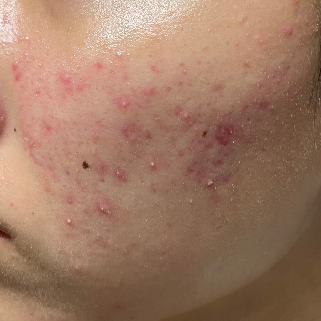 ドクタージャルト コントロールA ティーツリーメントスージングスポット/Dr.Jart+/その他スキンケアを使ったクチコミ(1枚目)